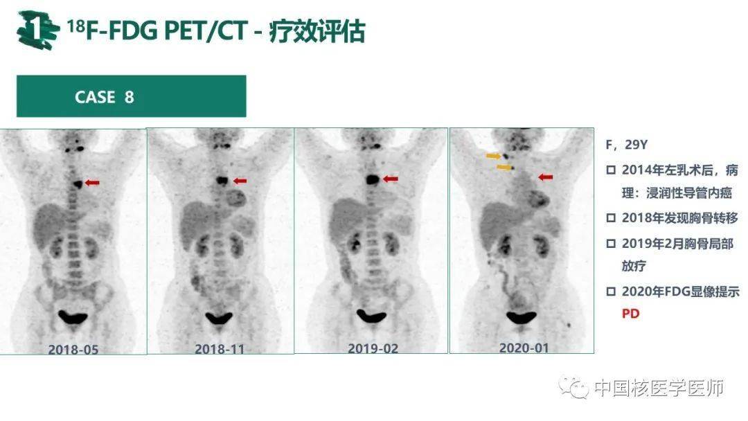 核汇园41期范岩乳腺癌petct应用进展