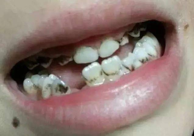 牙缝里为什么会有黑黑的东西?