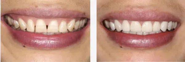 牙齿矫正后出现了黑三角,牙龈萎缩的情况还有救吗?
