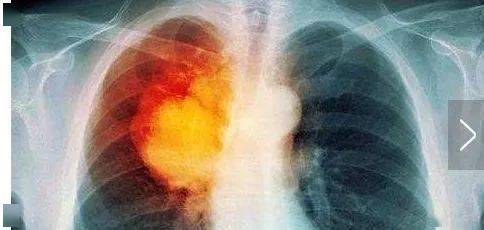 如何杀死癌细胞 98be99ee4d174541818e89c53ff24edb.jpeg