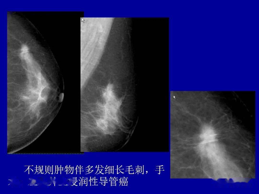 乳腺癌的影像诊断