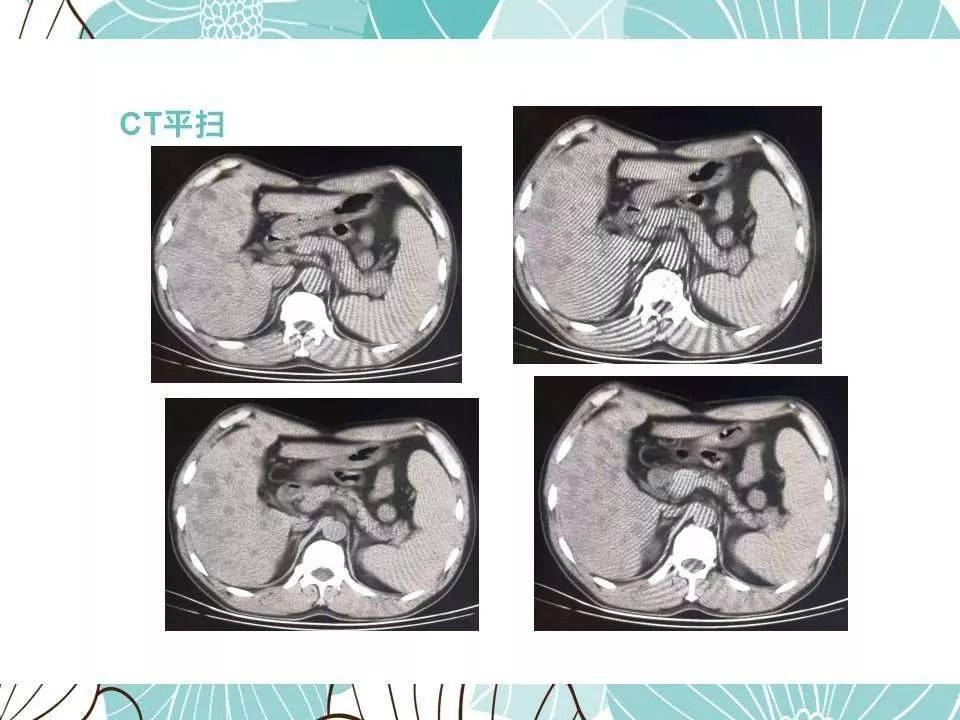 【每日一例1212】肝包虫病:54岁男,腹痛,肝区不适