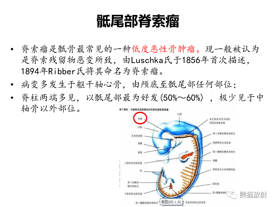 骶骨脊索瘤你想到了吗?有收获吗?