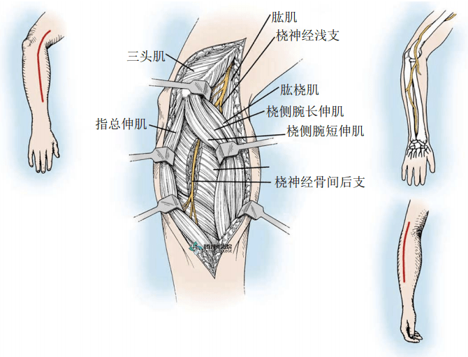 疼痛解剖学|桡管综合征