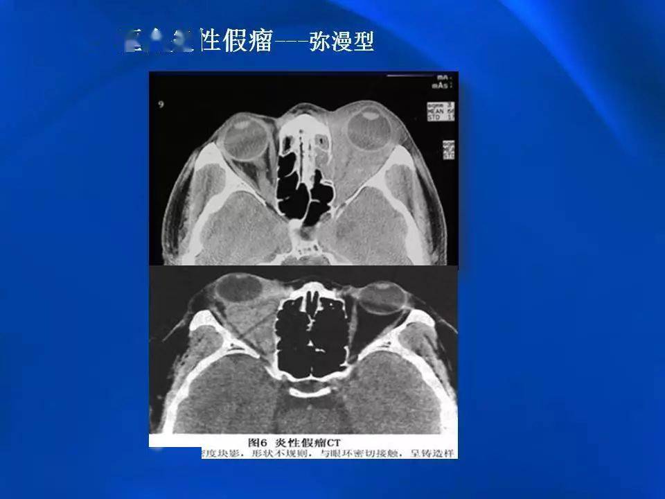 眶内炎性假瘤影像学表现