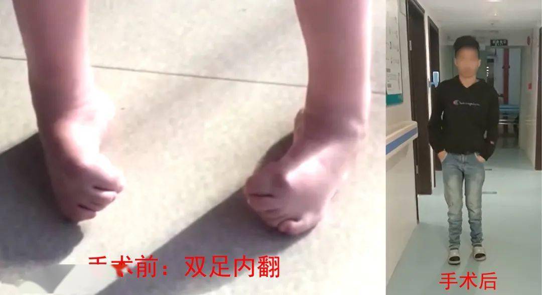 深圳先天性双足内翻患者 在正康骨科医院正常行走