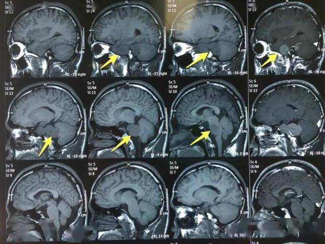 矢状位头颅ct示:鞍旁及桥小脑角区占位