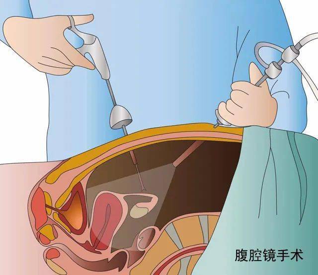 "小身材,大本事"——腹腔镜手术治疗妇科疾病蔚然成风
