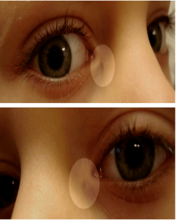 【泪器病】为什么我的眼角有个"洞"?