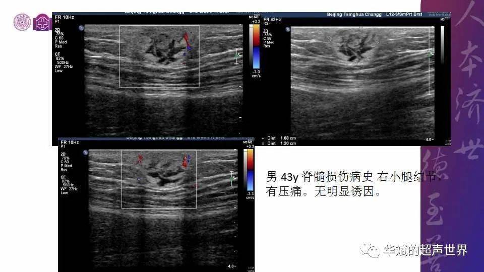 病例和文献复习:结节性筋膜炎_手机搜狐网