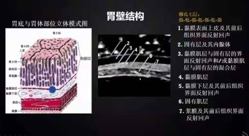 胃肠超声可以清晰显示胃肠壁结构及病变,既可以显示胃肠壁厚度,辨别
