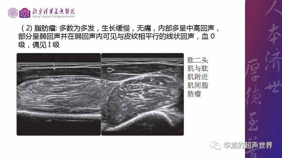 病例和文献复习结节性筋膜炎