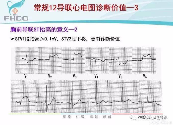 心肌缺血的心电图表现