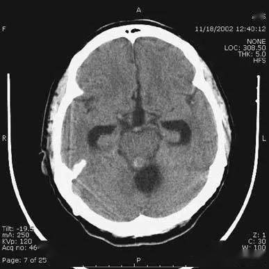 简明又详细的头部ct读片详解,收藏!_脑室
