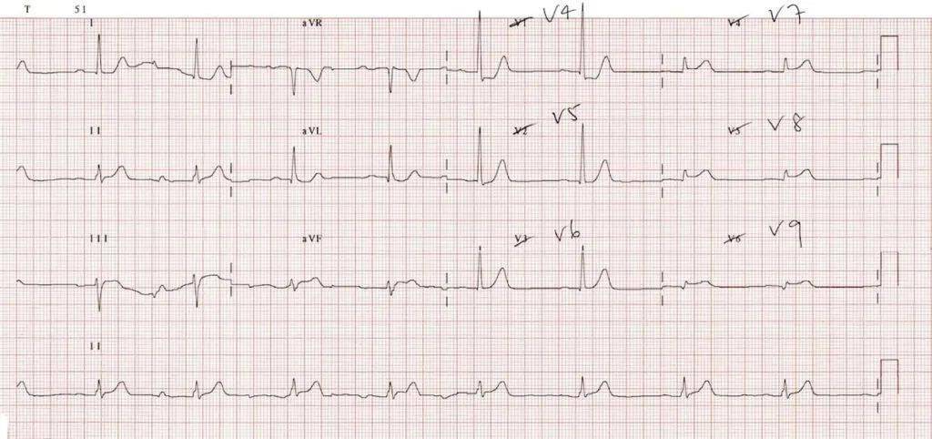 心肌缺血的心电图表现