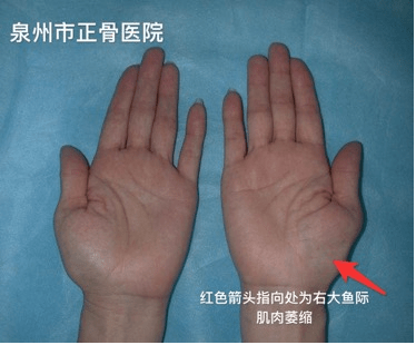 6.手部大鱼际肌有萎缩现象.