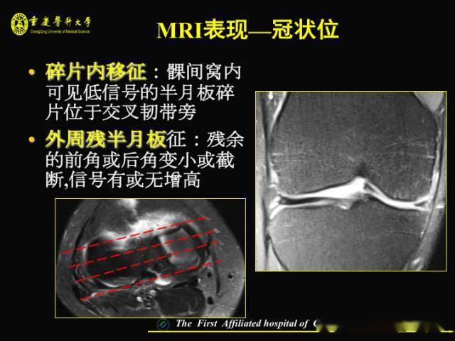 收藏!膝关节半月板 mri 入门,看这篇就够了