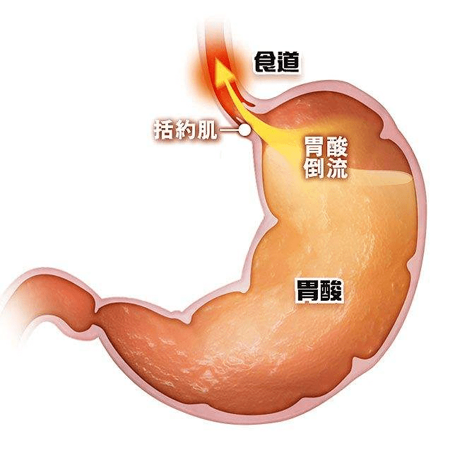 烧心是什么原理_烧心吃什么药