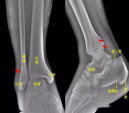 所示右侧腓骨远端见斜行骨折线,骨折端对位对线尚可.右腓骨远端骨折.