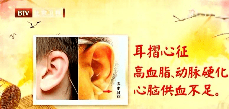 3  特殊的耳褶 在耳屏切迹和耳垂斜下方45度角有痕迹,这种情况被称为