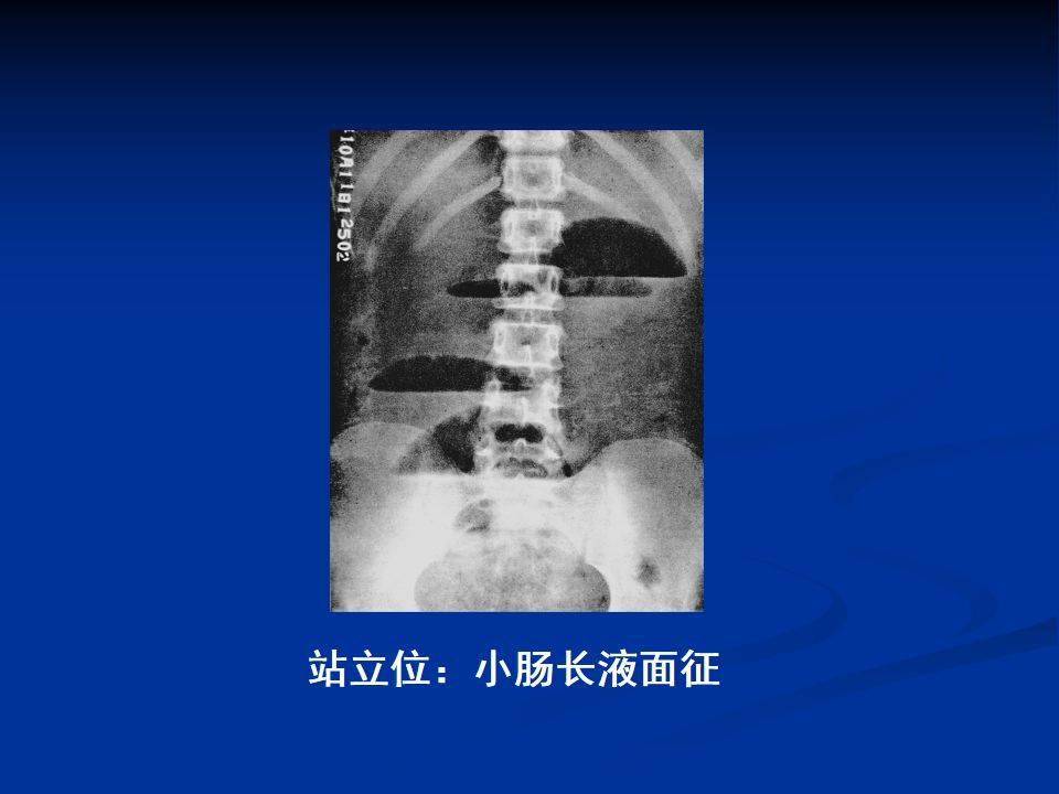 (高清图片 文字讲解)肠梗阻的分类及影像学表现