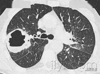 平片和ct:空洞是肺实变,肿块或者结节内的充气空隙,呈现透亮区或者低