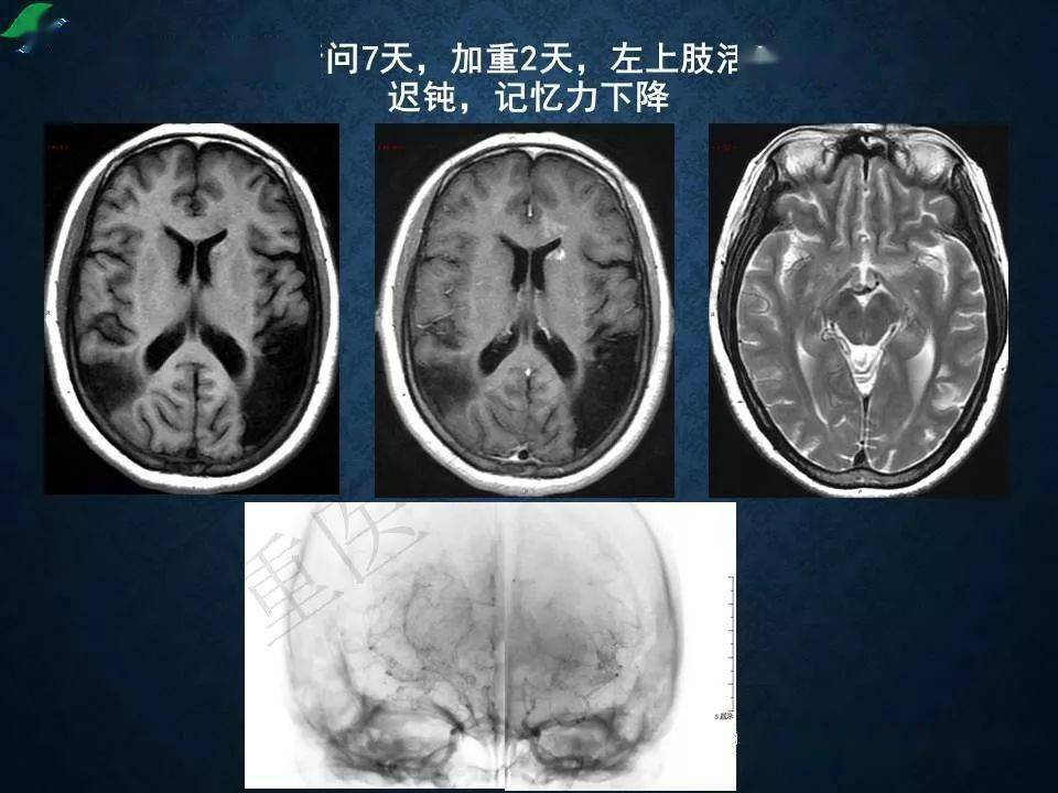 烟雾病的影像学诊断