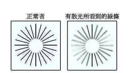 近视散光可以同时激光手术治疗吗?别再被谣言误导了!