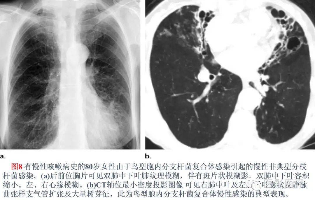 【图文详析】支气管扩张的机制,影像特征和病因
