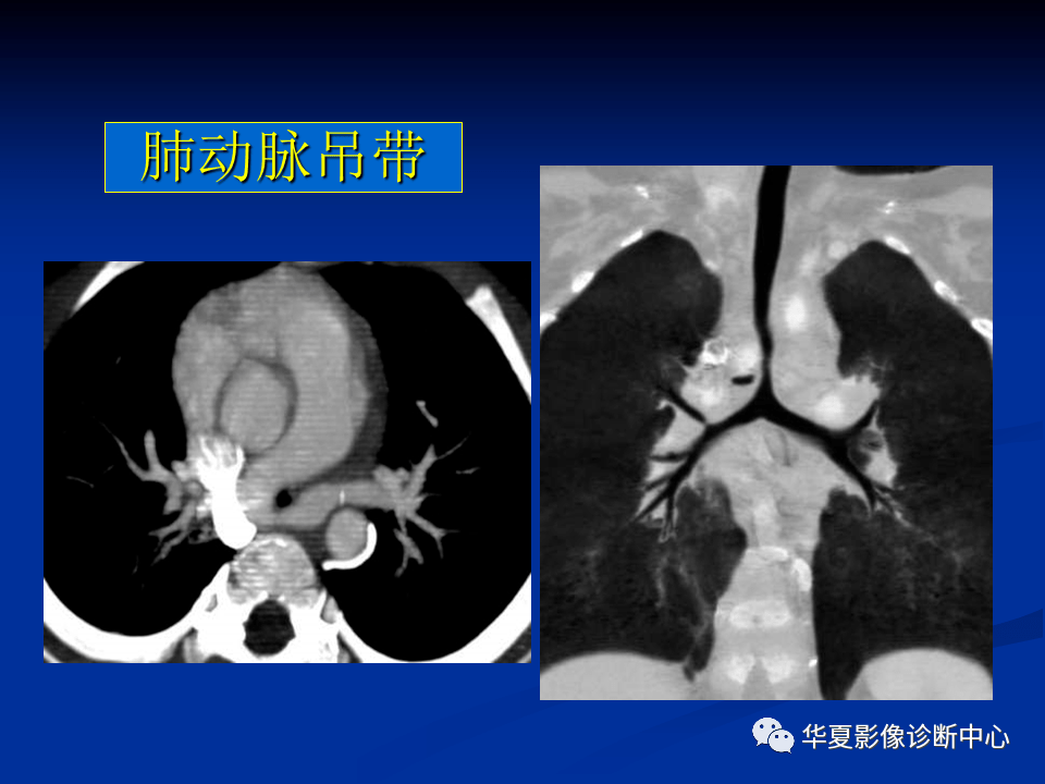 【影像精读】肺动脉吊带的影像学表现