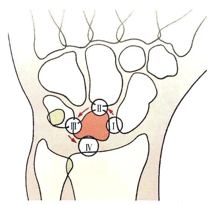 腕关节脱位及其x片阅读技巧