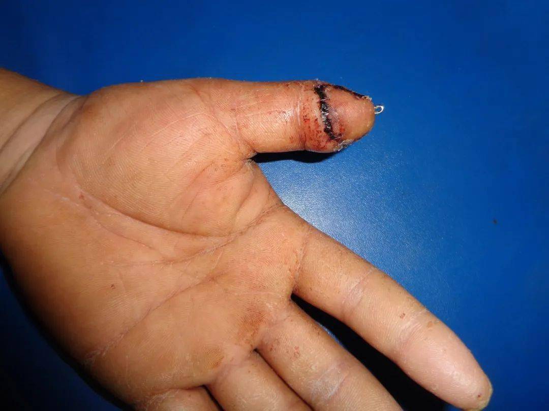 点赞县人民医院断指再植技术让手指奇迹复活