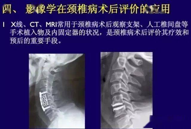 影像科医生不能诊断颈椎病,可以报告这6种诊断意见