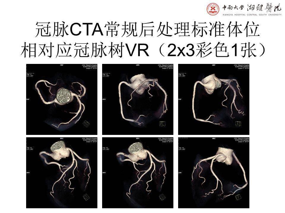 湘雅冠脉cta标准化后处理及规范化报告