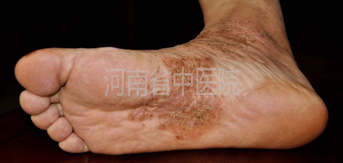 刘爱民教授皮肤病辨治典型案例分享(31)-足部湿疹1例