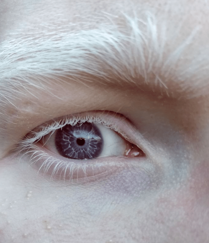 因为患有某种特殊的白化病,导致眼睛中缺少黑色素,因而形成了白色的