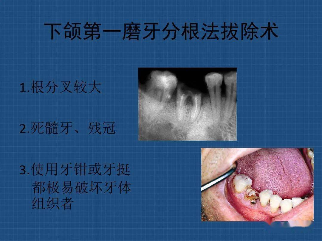 上下颌多根牙分根法