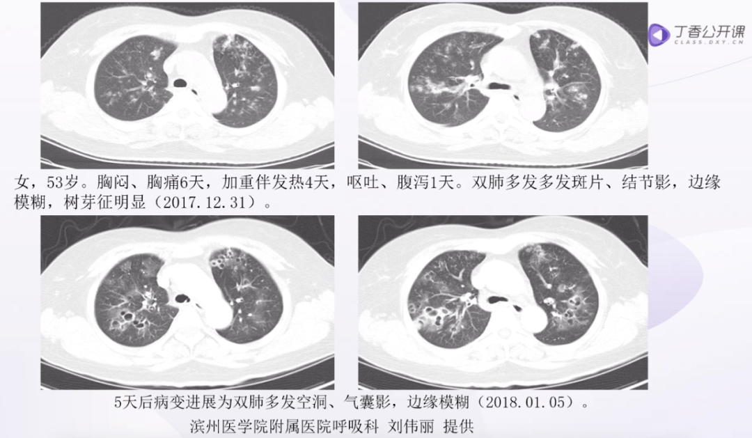 快速鉴别肺部各类感染ct影像特征