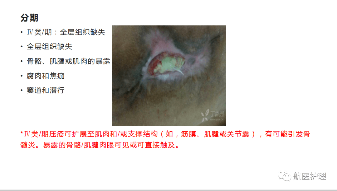 【ppt】压疮的诊断与预防