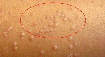 通常是  皮肤轻微破损之后,破损部位  感染了人乳头瘤病毒引起的.