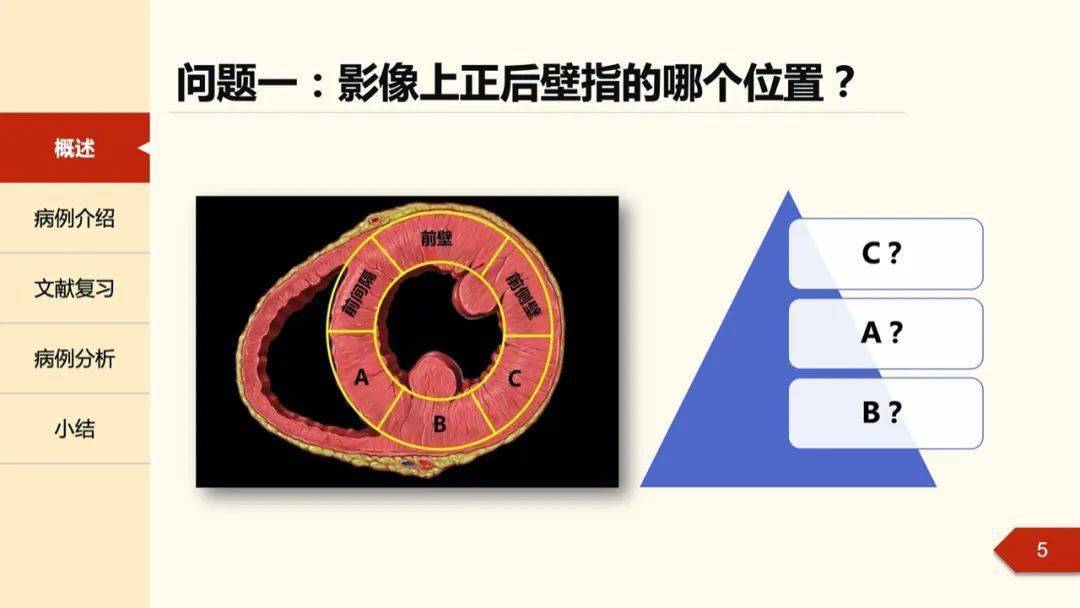 引起位于左心室侧壁与下壁之间的左心房室沟下部的心肌发生缺血而坏死