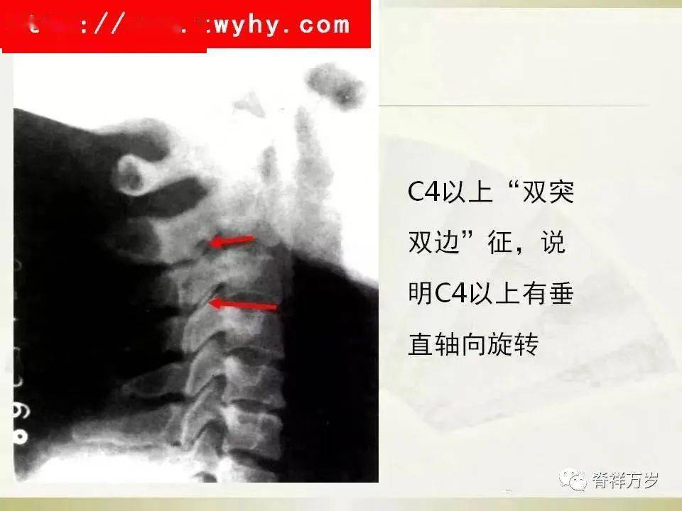 颈椎反弓的原因