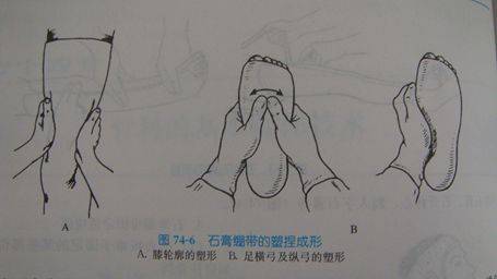 石膏绷带及夹板固定技术分享
