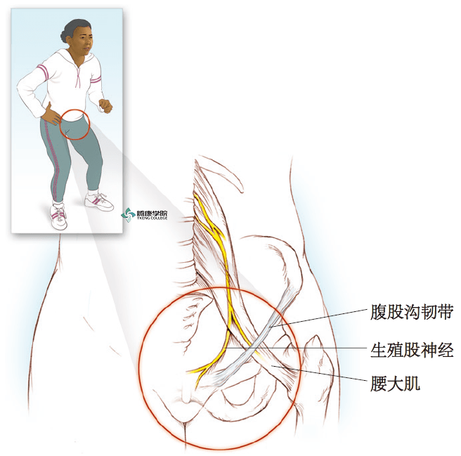 疼痛解剖学|生殖股神经痛