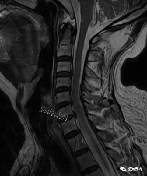 典型病例——颈椎后纵韧带钙化(mr)