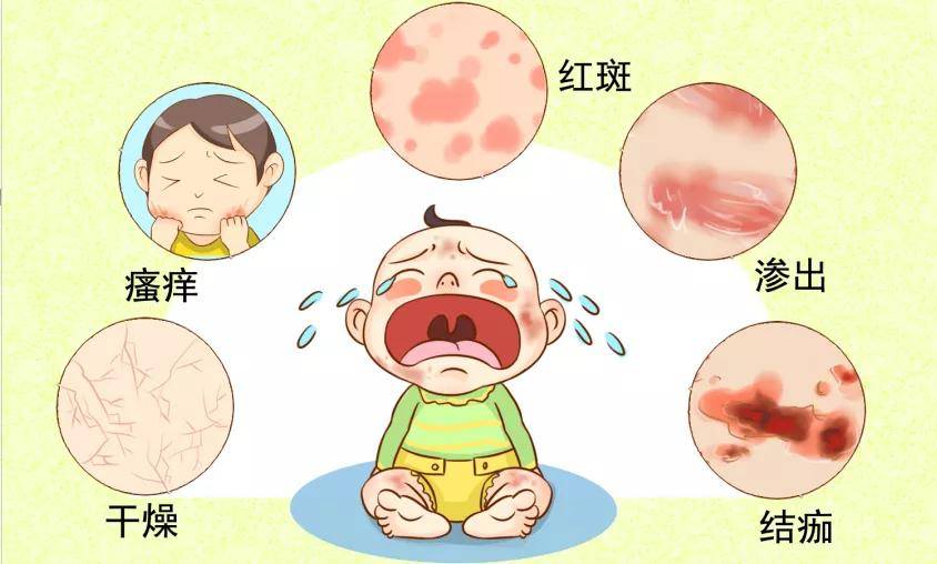 婴儿湿疹常见的六大误区,你踩雷了吗?