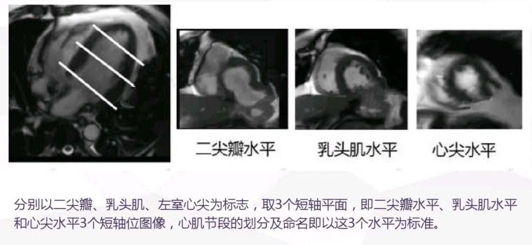 心脏磁共振成像中心肌节段如何划分