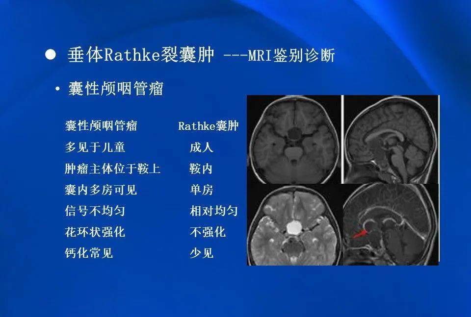 影像拉克氏囊肿的mri表现及鉴别诊断