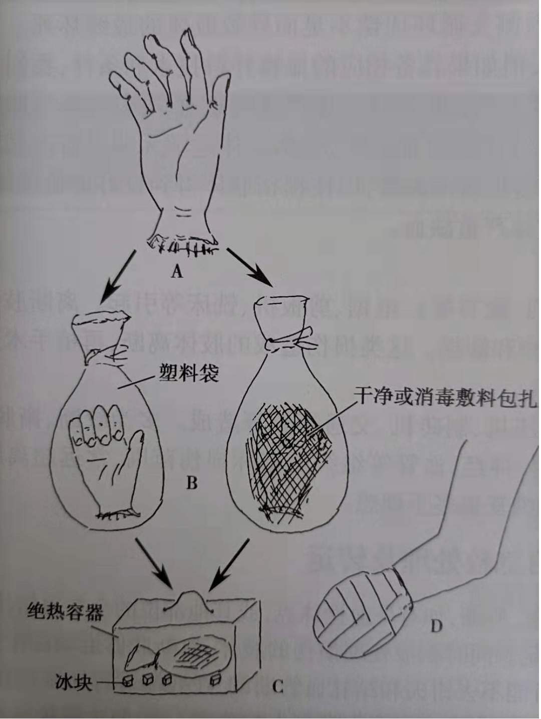 手指断了怎么办