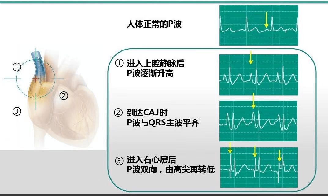 【医疗前沿】我院成功开展首例ecg定位下隧道式picc置管术
